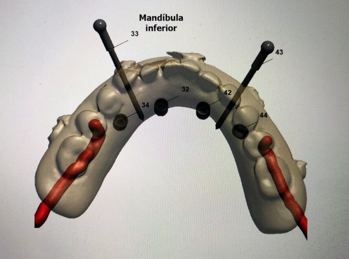 Cirurgia Guiada De Implantes Quais SÃo As Vantagens Coei Odontologia 4130