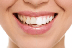 4 opções de tratamento para clarear os dentes