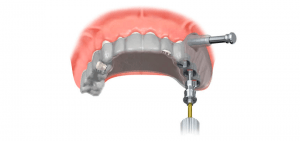 Implante dentário guiado